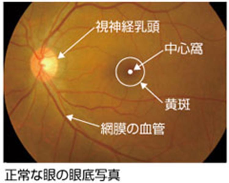 正常な目の眼底写真