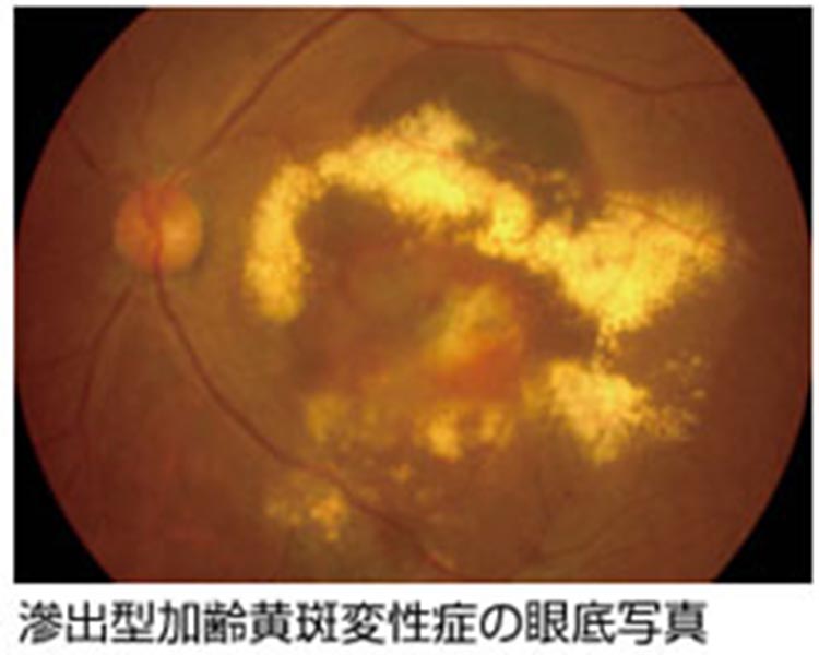 滲出型加齢黄斑変性症の眼底写真