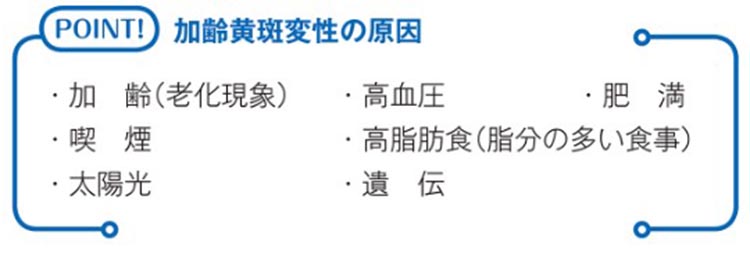 加齢黄斑変性の原因　加齢（老化現象）、高血圧、肥満、喫煙、高脂肪食（脂分の多い食事）、太陽光、遺伝