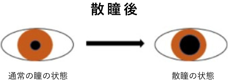 「通常の瞳の状態」と「散瞳の状態」を比較するイラスト