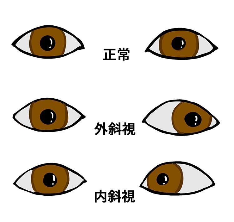 斜視イメージ